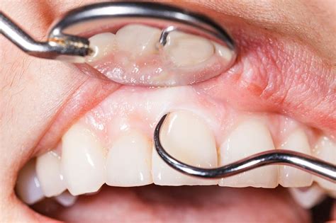 Encías Inflamadas ¿por Qué Sucede Sanz Clínica Dental