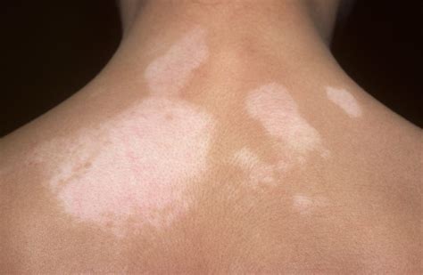 Skin Manifestations Of Thyroid Disorders A Review Dermatology Advisor