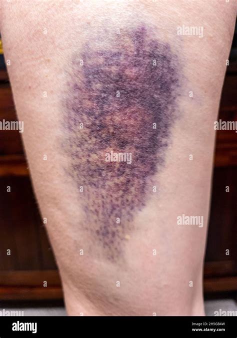 Large Coloured Bruise Damage On Upper Leg Hematoma Stock Photo Alamy