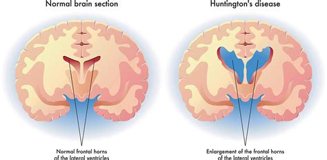 Huntingtons Disease Symptoms Treatments And Causes Healthdirect