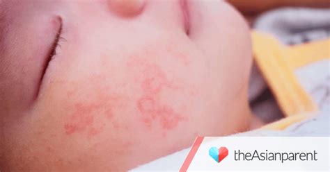 How To Identify Treat And Prevent Heat Rash Or Prickly Heat
