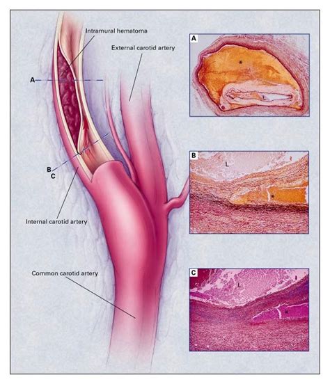 Spontaneous Dissection Of The Carotid And Vertebral Arteries Nejm