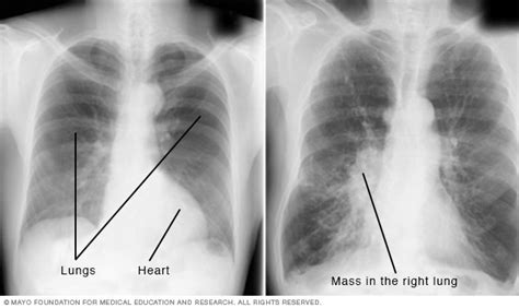Will A Chest X Ray Detect Cancer Cancerwalls