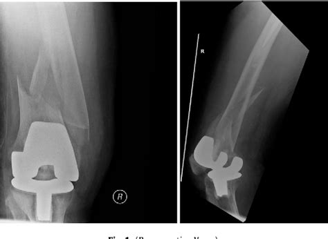 Management Of Periprosthetic Distal Femur Fractures Using Distal Femoral Arthroplasty And ﬁ