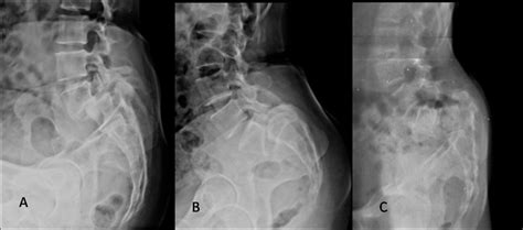 Section 19 Chapter 4 High Grade Spondylolisthesis Pediatric And