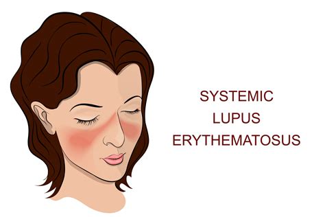 Lupus Erythematosus In Adults Qualmedica Research Owensboro Ky