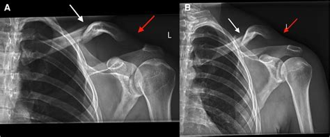 Frontiers Case Report Midshaft Clavicle Fracture With Concomitant