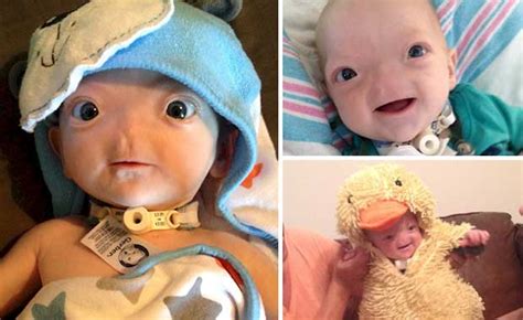 Baby Born Without A Nose Is The Internets Happiest Most Adorable Baby