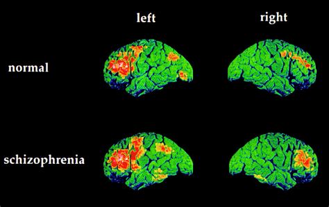Colour Pet Brain Scans Of Schizophrenic Speaking Photograph By Wellcome