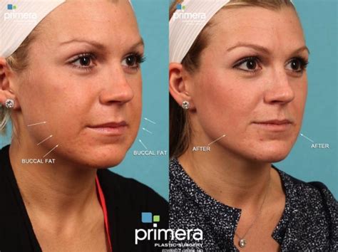 Buccal Fat Removal Photos Orlando Fl