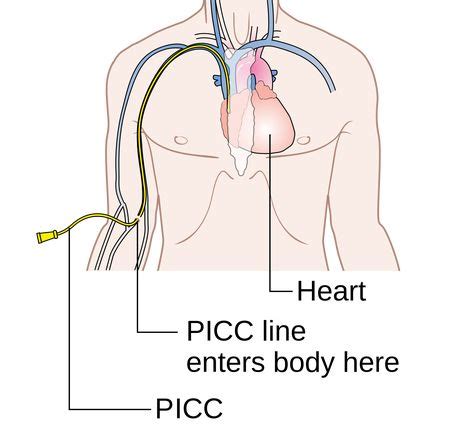 Complications And Care Of Peripherally Inserted Central Catheters Picc
