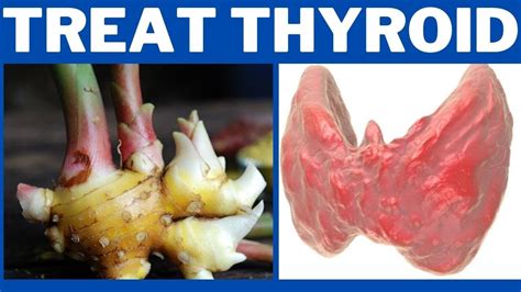 Natural Remedies To Cure Thyroid At Home Youtube