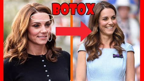 Did Kate Middleton Really Get Botox One Rumor The Palace Is Eager To