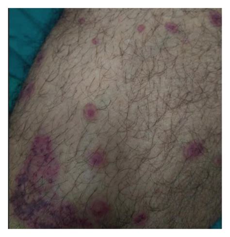 Purpuric Rash Scattered Over The Patients Lower Limbs Download