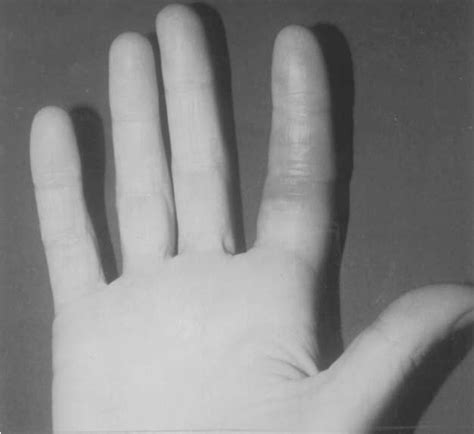 Figure 1 From Paroxysmal Finger Haematomas Achenbachs Syndrome With