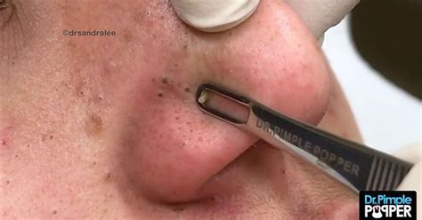 Why People Cant Stop Watching Pimples And Blackheads Getting Squeezed