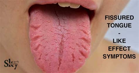 Fissured Tongue Also Known As Scrotal Tongue Food Dentistry Dental Photos