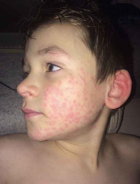 Allergic To Cold A Teenage Boys Life With Cold Urticaria And No