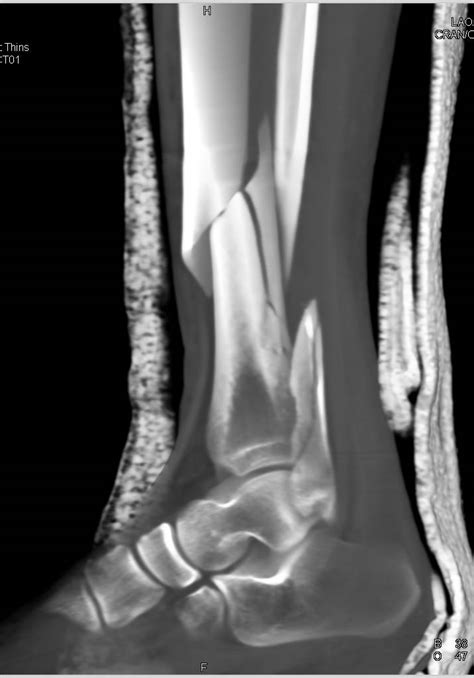 Spiral Fracture Ankle Pain Avulsion Fracture Ankle Lateral Malleolus