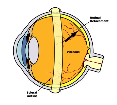 Scleral Buckle — The Retina Institute