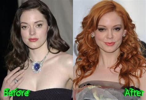 Rose Mcgowan Plastic Surgery You Be The Judge