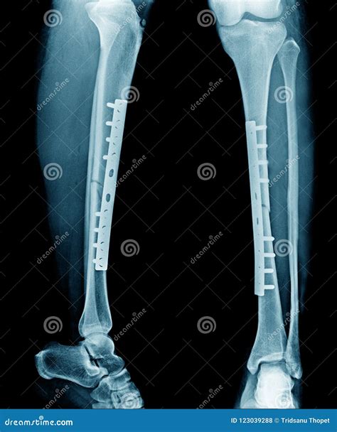 Fracture Tibia Bone With Post Op Fixation Stock Photo Image Of