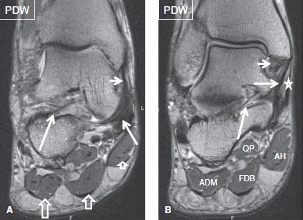 Hi, i had surgery on my shoulder about 8 years ago and have two metal anchors in my shoulder. The Ankle | Musculoskeletal Key