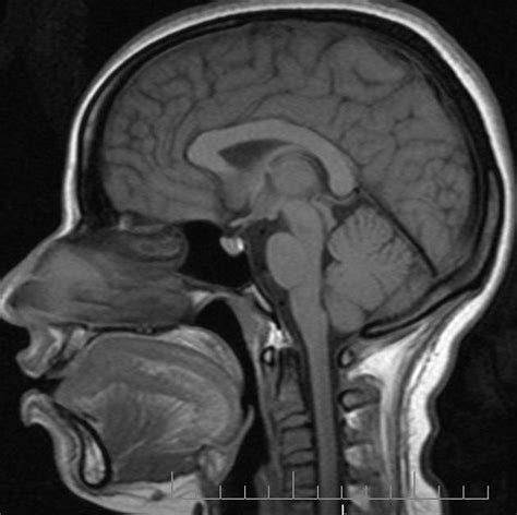 Pituitary Microadenoma Dynamic Mri Radiology Case