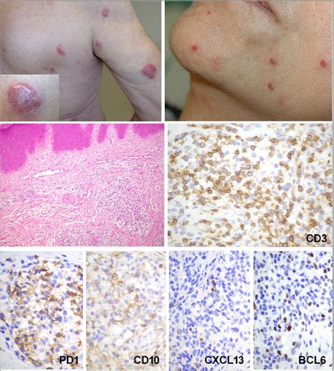 Primary Cutaneous Peripheral T‐cell Lymphomas With A T‐follicular