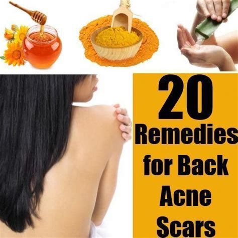 Best Way To Get Rid Of Acne Backacne Back Acne Remedies Back Acne