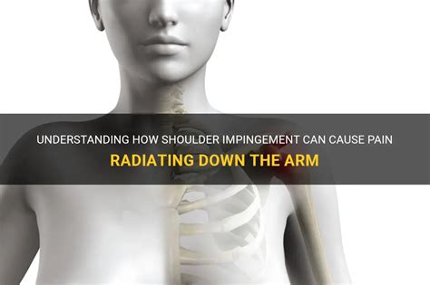 Understanding How Shoulder Impingement Can Cause Pain Radiating Down