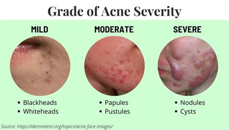 Guide To Acne And Acne Treatment Essential Life Skin Products
