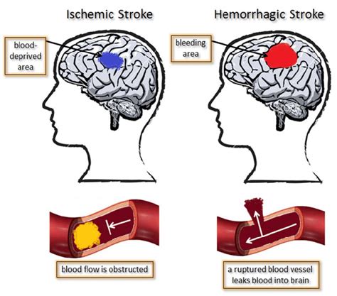 Hemorrhagic stroke is when blood escapes from a damaged or weakened blood vessel in the brain. Ischemic versus hemorrhagic stroke. | Download Scientific ...
