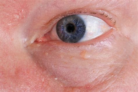“la Afectación Ocular Del Herpes Zóster Puede Dejar Secuelas Visuales