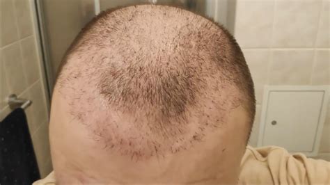 2 Hair Transplants 2 Months Update Shock Loss 🇹🇷 Youtube