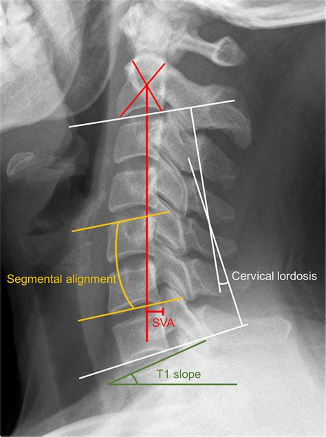 Radiological Evaluation Of The Cervical Sagittal Alignment Parameters