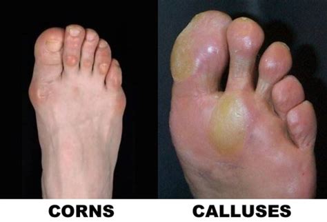 Corns And Calluses Treatment