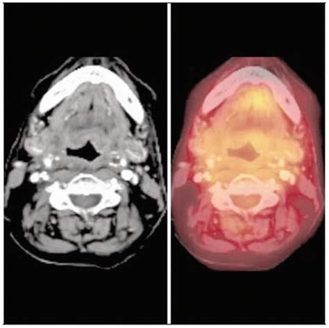 Head And Neck Cancer Squamous Radiology Key