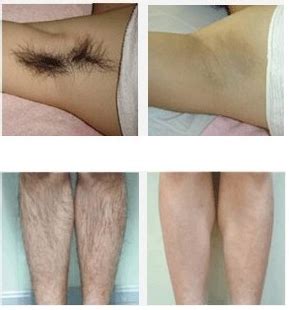 Moreover, we have to do a lot of effort to get reasonable results. 808- hair removal before after | Diode laser hair removal ...