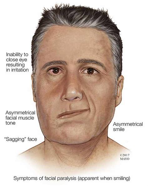 Signs And Symptoms Of Bells Palsy Mayo Clinic News Network