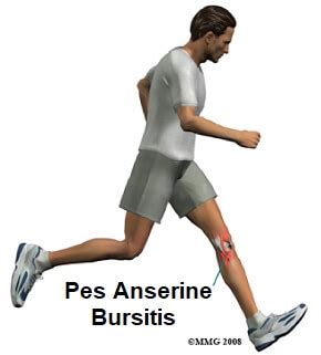 Pes Anserine Bursitis Causes Treatment Knee Pain Explained The Best Porn Website