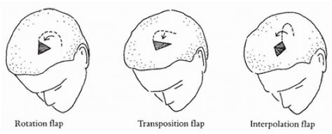 Scalp Flaps And The Rotation Forehead Flap Plastic Surgery Key