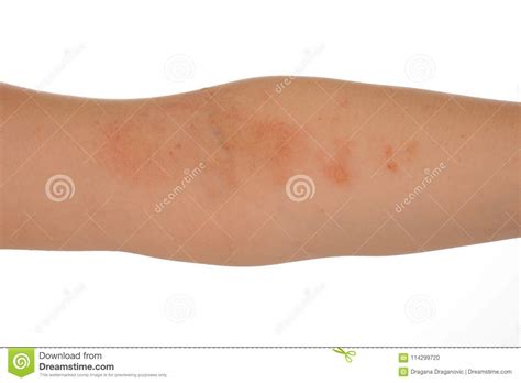 Dermatitis Eczema On The Skin Of The Woman`s Arm Stock Photo Image Of