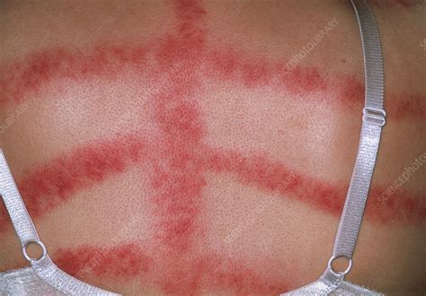 Skin Allergy Stock Image M3200289 Science Photo Library