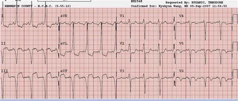 Dr Smiths Ecg Blog Repost A Certain Pattern Of