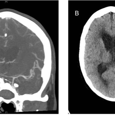 Ct Angiography A Confirms The Presence Of Severe Cerebral Vasospasm