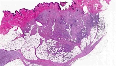 Pathology Outlines Dermatofibrosarcoma Protuberans Dfsp
