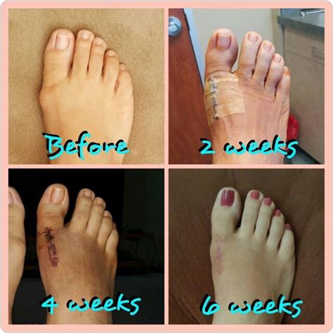 Bunion Surgery Before And After Picture Only Bunion Surgery Bunion