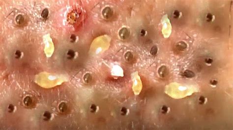 Nguyen Spa Blackheads