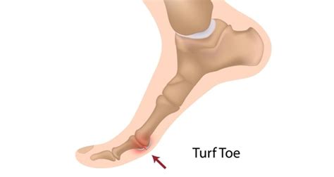 Turf Toe Symptoms Causes Treatment And Taping